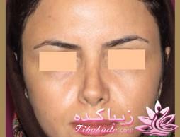 جراحی بینی - جراحی زیبایی